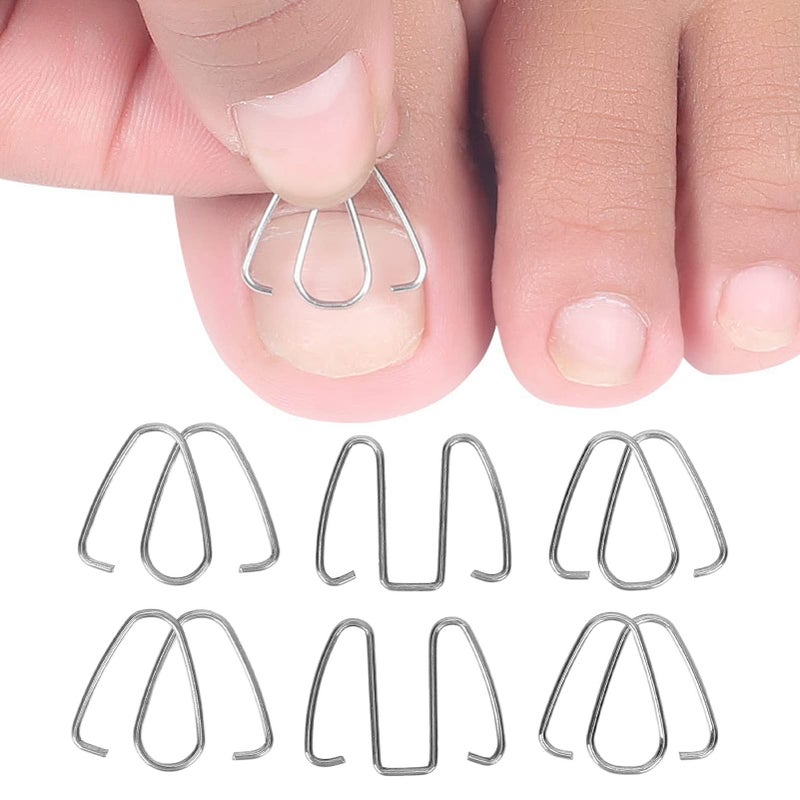 Nail Corrector Ingrown Toe Nail Wire Lifter Fixer Recover Tool Bunion Corrector for Pedicure Foot Care