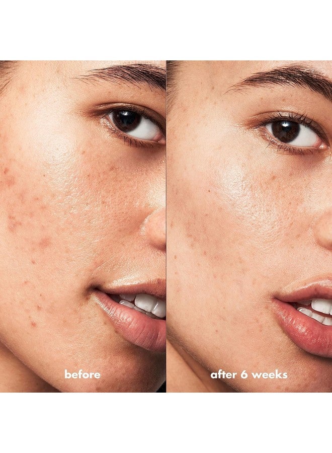 elf e.l.f. SKIN Blemish Breakthrough Acne Fighting Spot Gel, Roll-on For Treating Blemishes, Made With Salicylic Acid, Vegan & Cruelty-Free - Image 4