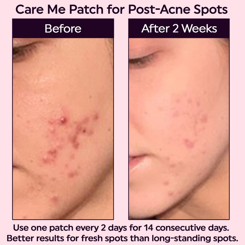 Care Me Microdart Dark Spot Patch with 127 Micropoints (1 Pack of 9 Patches) â€“ Fades & Brightens Acne Marks, Dark Spots & Discoloration â€“ Post-Acne Treatment for Clearer Skin - Image 5