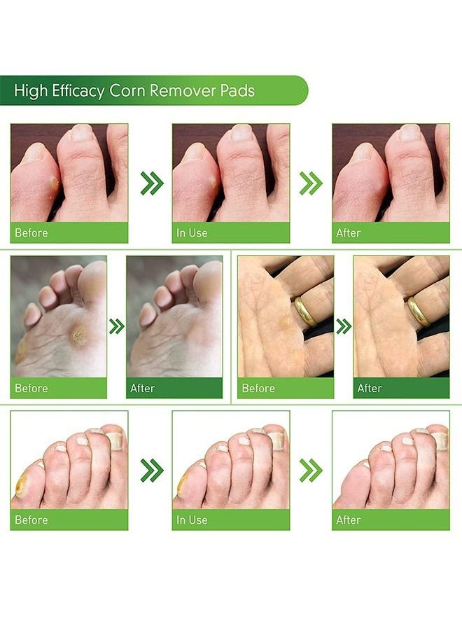 Sumifun - 42 Pcs Foot Corn Removal Plaster, Natural Ingredients, Foot Care Expert, Calluses Plantar Treatment, Relief Pain From Calluses, Corns, Blisters, Heel Frictions - Image 1