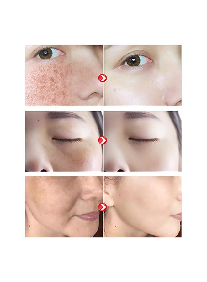 Hoygi Brigentening And Freckle Removing Essence,Whitening And Freckle Removing Essence, Magic Whitening Spot Cream, Vitamin C Whitening Freckle Cream, Anti-Spot Serum for Face 40ml  - Image 3