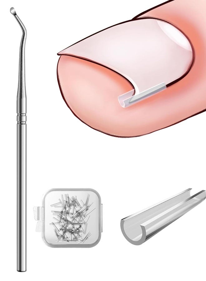 50 Ingrown Toenail Filler Sleeves Orthognathic Pads C-Shaped Nail Groove Pads Ingrown Toenail Correctors Pedicure Tools - Image 1