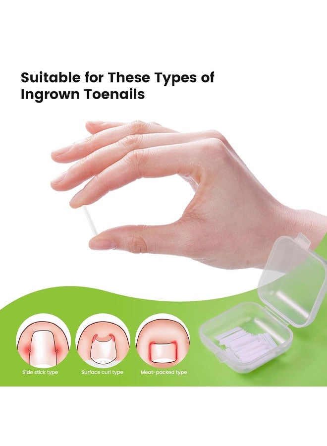 50 Ingrown Toenail Filler Sleeves Orthognathic Pads C-Shaped Nail Groove Pads Ingrown Toenail Correctors Pedicure Tools - Image 4