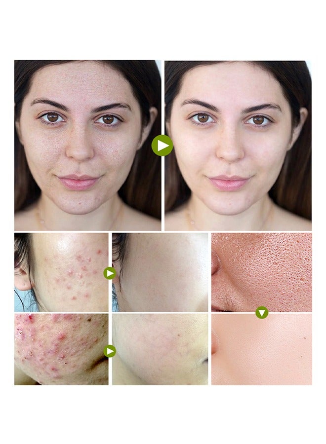 Breylee Acne Treatment Cream, Acne Removal Acne Pimple Repair Cream, Natural Cystic Acne Treatment, Premium Acne Scar Cream And Pimple Remover, 20G - Image 4