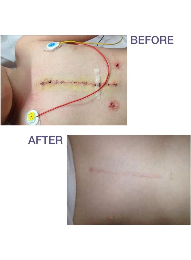 PROSIL Kids Pro-Sil 4.25g Silicone Stick for Scars - Image 4