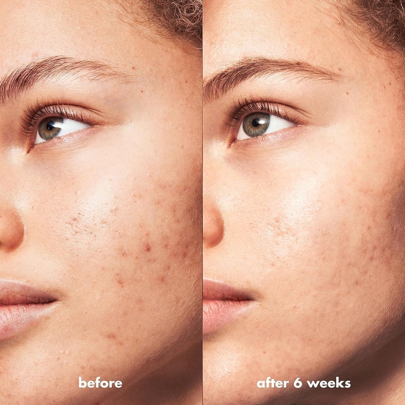 elf e.l.f. SKIN Blemish Breakthrough Triple-Acid Resurfacing Serum, Hydrating Night Serum For Fighting Blemishes, Helps Improve Skin Tone & Texture - Image 3