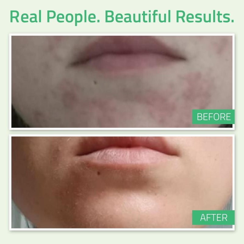 YEOUTH Glycolic Acid Peel for Face, At Home Chemical Exfoliator AHA 30% Glycolic Acid Face Peel with Retinol, Designed to Refresh and Smooth the Appearance of Skin 2oz - Image 4