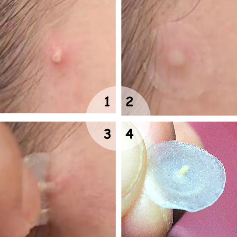 36pcs/Sheet Transparent Hydrocolloid Pimple Patch Pimple Covering Concealing Sticker Patch - Image 5