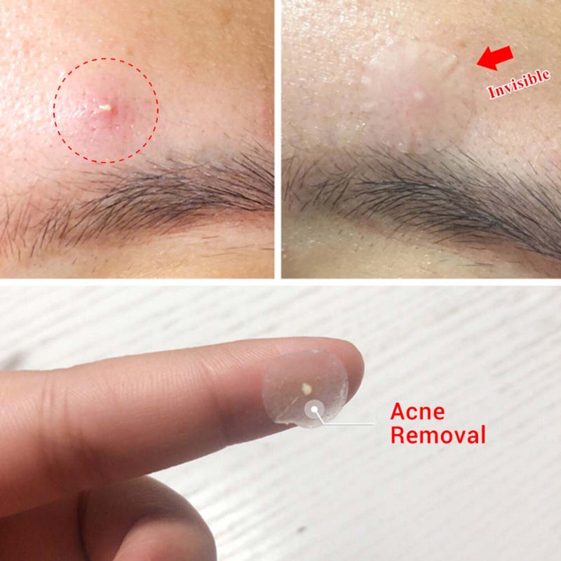 36pcs/Sheet Transparent Hydrocolloid Pimple Patch Pimple Covering Concealing Sticker Patch - Image 3