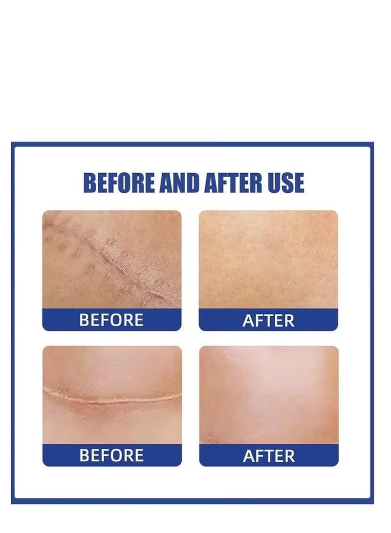 إيلهو شرائط سيليكون طبية لإزالة الندبات – قابلة لإعادة الاستخدام والغسل – 4 أزواج لعلاج ندبات الثدي بعد الجراحة - Image 5