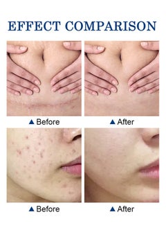 CARVENCHY Scar Removal Cream - Acne Scar Cream Rapid Repair Scar Cream for Acne Surgery Injury Burns Advanced Gel Acne Scar Spot Treatment Suitable for All Skin Types 30g  - Image 5