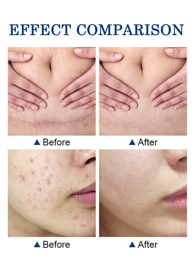 CARVENCHY Scar Removal Cream - Acne Scar Cream Rapid Repair Scar Cream for Acne Surgery Injury Burns Advanced Gel Acne Scar Spot Treatment Suitable for All Skin Types 30g - Image 5