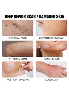 CARVENCHY Scar Removal Cream - Acne Scar Cream Rapid Repair Scar Cream for Acne Surgery Injury Burns Advanced Gel Acne Scar Spot Treatment Suitable for All Skin Types 30g  - Image 3