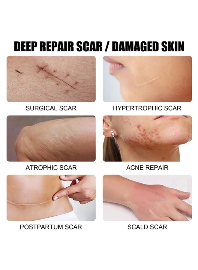 CARVENCHY Scar Removal Cream - Acne Scar Cream Rapid Repair Scar Cream for Acne Surgery Injury Burns Advanced Gel Acne Scar Spot Treatment Suitable for All Skin Types 30g - Image 3