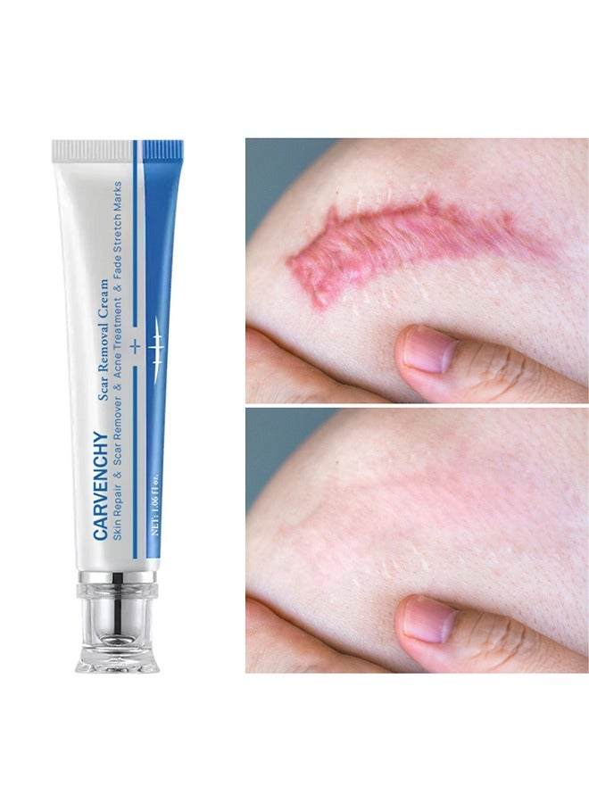 CARVENCHY Scar Removal Cream - Acne Scar Cream Rapid Repair Scar Cream for Acne Surgery Injury Burns Advanced Gel Acne Scar Spot Treatment Suitable for All Skin Types 30g - Image 2