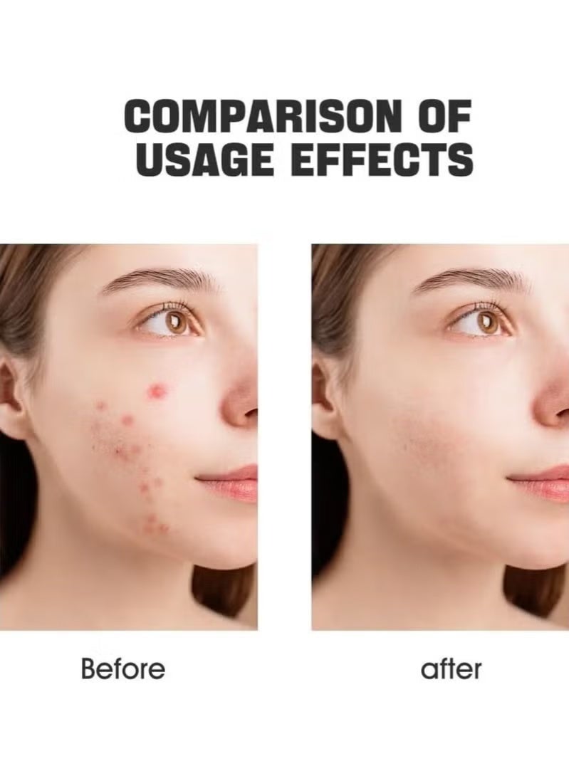 ATRJSZ Invisible Acne Patches, Overnight Smoothing | Innovative Midline Design (150 Count) - Image 4