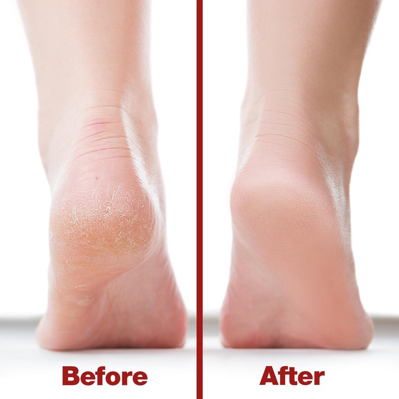 Probelle Double Sided Multidirectional Nickel Foot File Callus Remover - Immediately Reduces calluses and Corns to Powder for Instant Results, Safe Tool (Red) - Image 4
