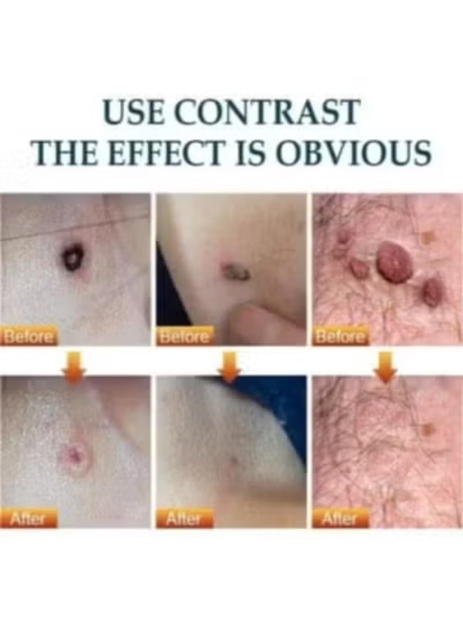 Sumifun Gentle, Irritation-Free Wart & Skin Tag Removal Cream - Image 3