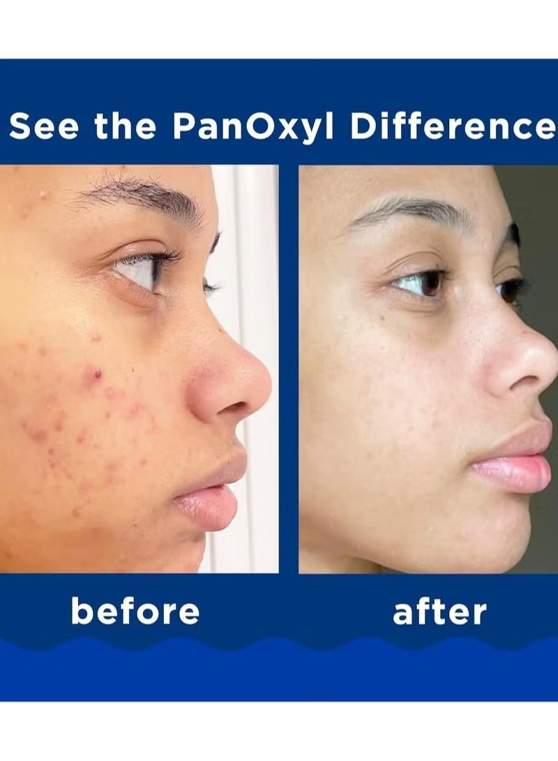 Panoxyl Benzoyl Peroxide 10% Acne Foaming Wash, Maximum Strength Antimicrobial, 5.5 oz. 156grams - Image 2