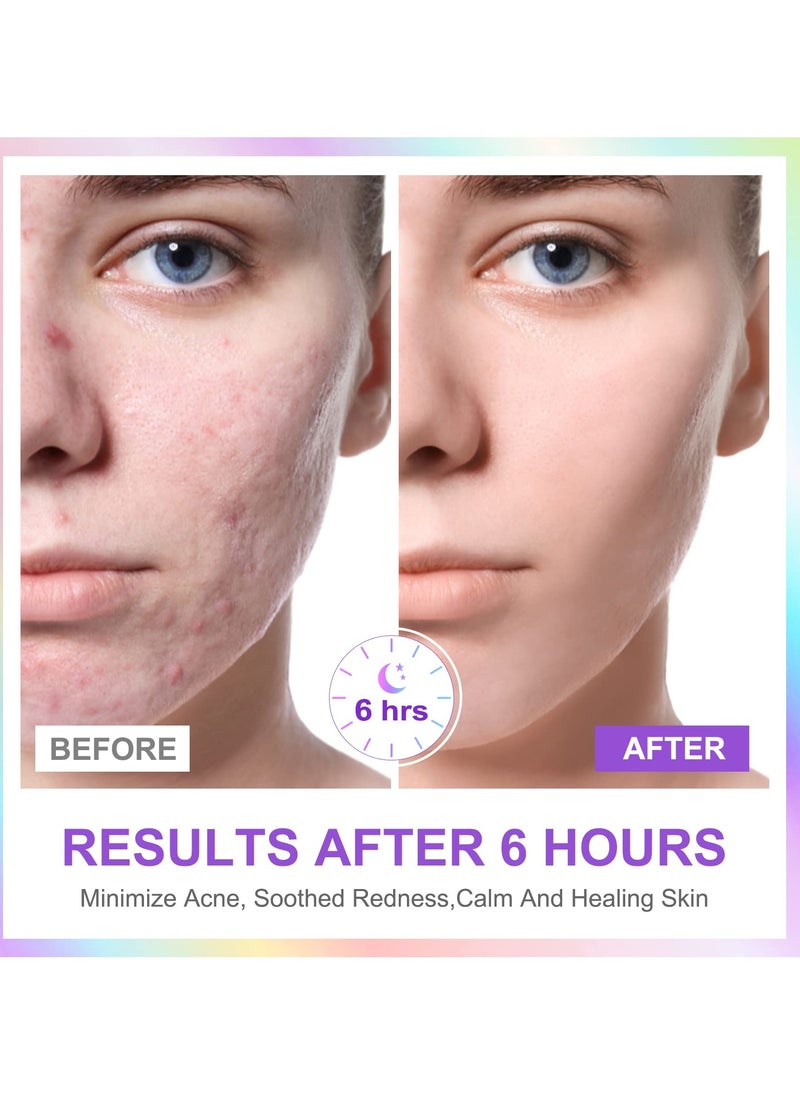 SYOSI - Acne Pimple Patch Invisible Hydrocolloid Acne Patch with Natural Green Algae Extract Tea Tree Oil for Face Acne Reduce Acne Spot Healing Patch Zit Patches for Face - Image 1