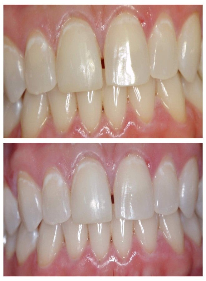 Ultra White جل تبييض الأسنان الأبيض الفائق 22% - 5 أنابيب كبيرة 3.8 مل من الجل للحصول على ابتسامة بيضاء جميلة - Image 5