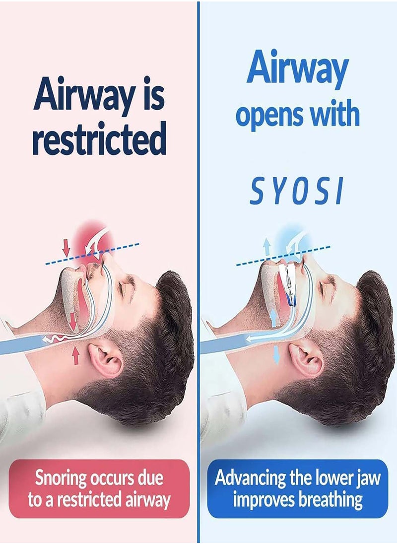SYOSI - Anti-snoring Device Mouthpiece, Upgraded Adjustable Mouth Type Silicone Anti-snoring Device, Help Sleep at Night, Prevent Snoring and Snoring, Anti-grinding Braces Snoring Device (Standard Size) - Image 1