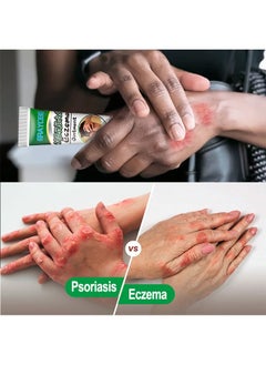 ERAYCEE Treatment Psoriasis Eczema Cream Antibacterial Antipruritic Dermatitis Herbal Ointment Anti-itch Medical Plaster  - Image 4