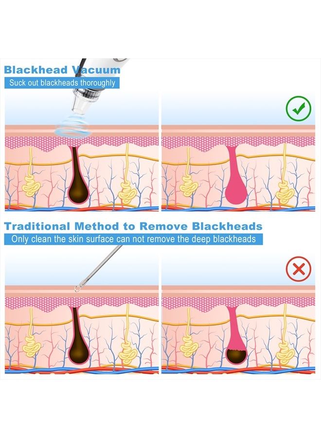 EUASOO Blackhead Remover, EUASOO USB Rechargeable Pimple Extractor, Electric Pore Vacuum Blackhead Remover Tools for Women & Men, Blackhead Vacuum Kit with 10 * Filter Sponge & 5 * Rubber Ring & etc. - Image 4