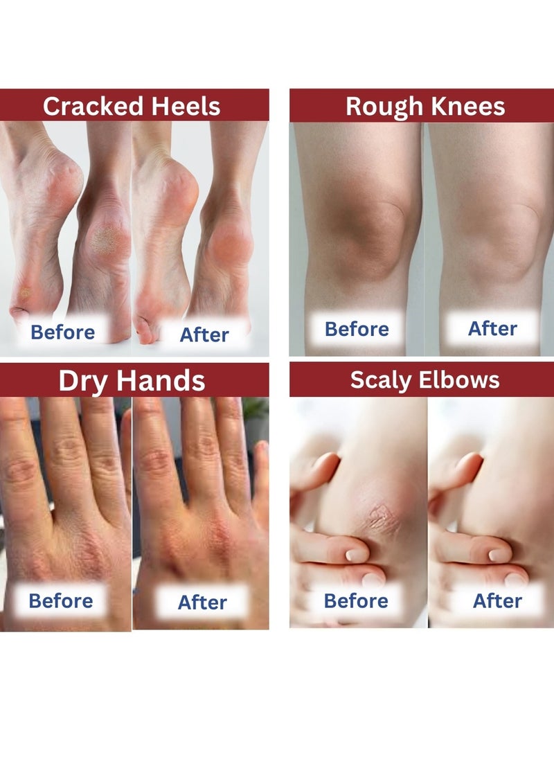 ARTKEN - 42% Urea Cream Plus 2% Salicylic Acid Cream for Cracked Feet Hands Callus Remover Hand Cream Foot Cream for Cracked Foot Heels Elbows Nails Knees Skin Moisturizer Urea Lotion with Maximum Strength 50G - Image 1
