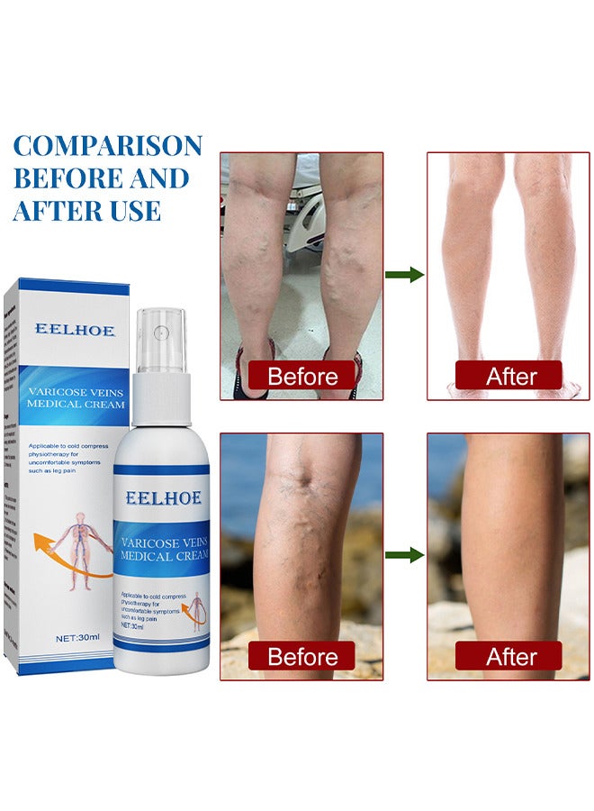 EELHOE Varicose Veins Medical Cream, Eliminate And Spider Veins Spray, Varicose Veins Relief, Improve Blood Circulation, Soothes Tired Legs, Antiedema, Improve Blood Circulatio Quickly Soothing Swelling 30ML  - Image 2