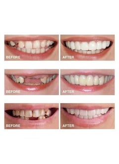 Teeth Veneers, Smile Instant, Temporary Tooth Kit Decoration, Perfect Braces, Whitening Alternative, No Pain Fix Smile - pzsku/Z60CF379D26EA8451306BZ/45/_/1720599328/db59eaf6-81ed-49ba-b9e2-2d0ae64d1132