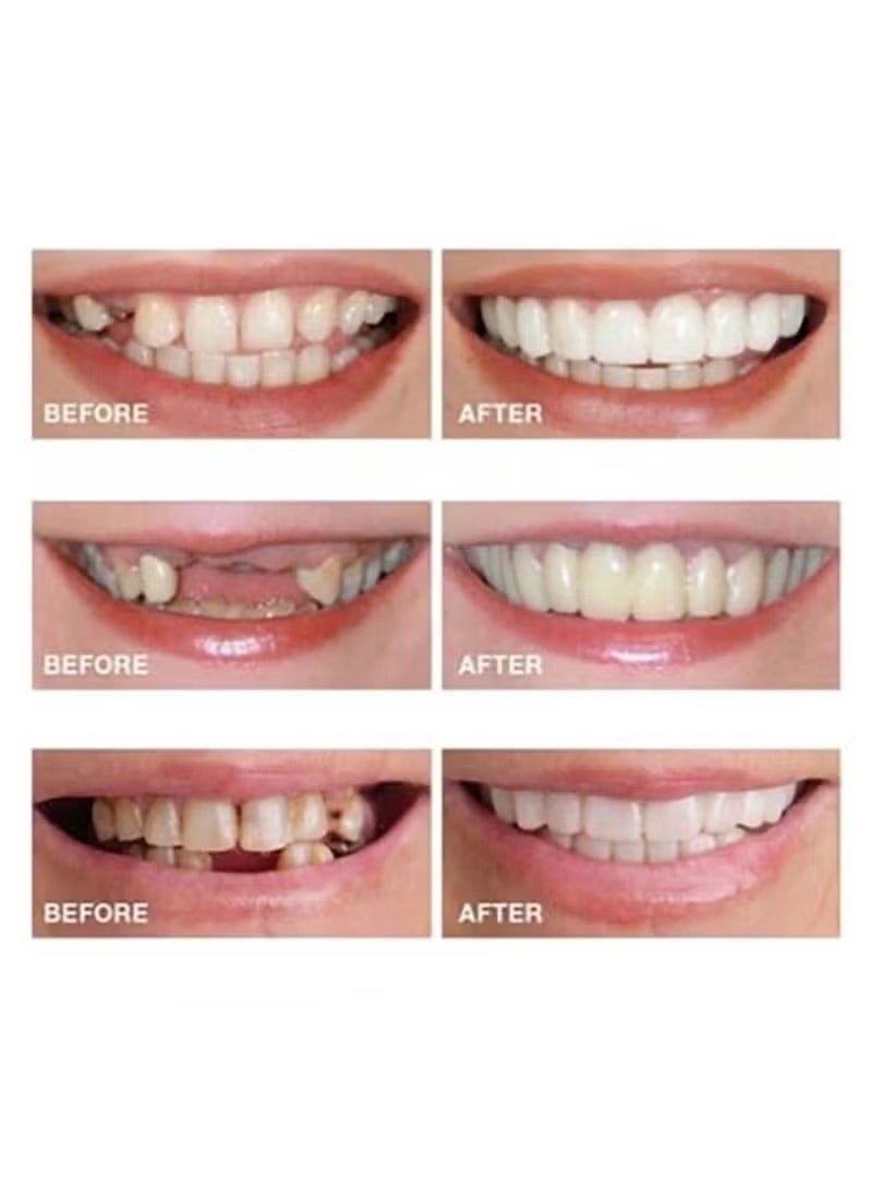 Generic Teeth Veneers, Smile Instant, Temporary Tooth Kit Decoration, Perfect Braces, Whitening Alternative, No Pain Fix Smile  - Image 2