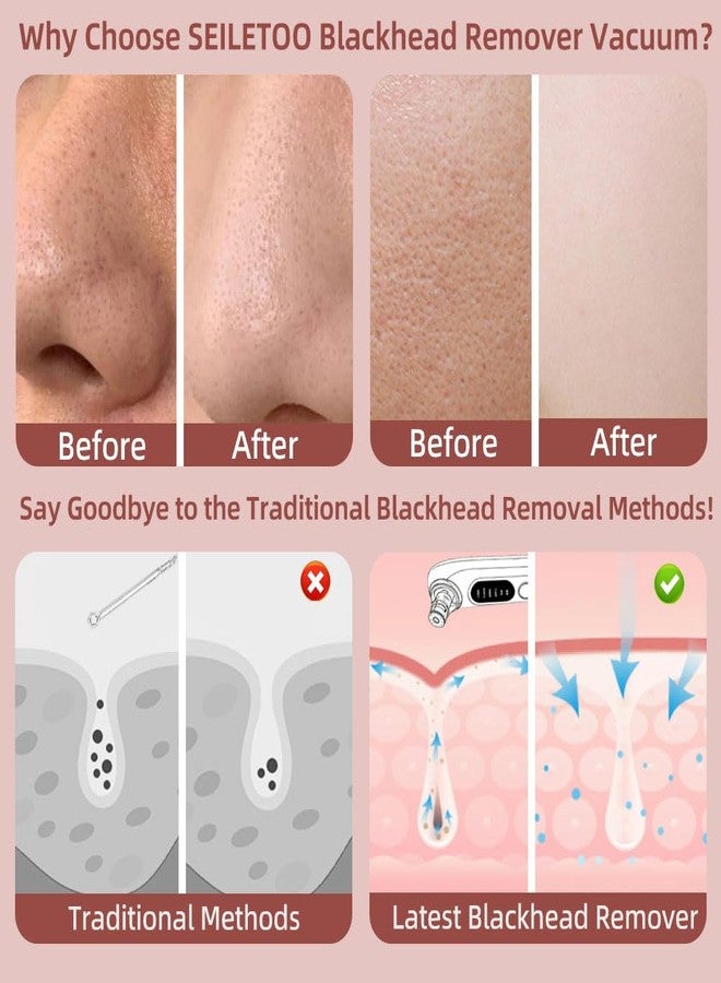 SEILETOO 5-Speed ​​Blackhead Remover Vacuum, Wireless Charging Nose Pore Extractor with 4 Removable Heads,Facial Vacuum Pore Cleaner,30-Second Keratin Softening, Hypoallergenic Deep Cleansing - Image 2