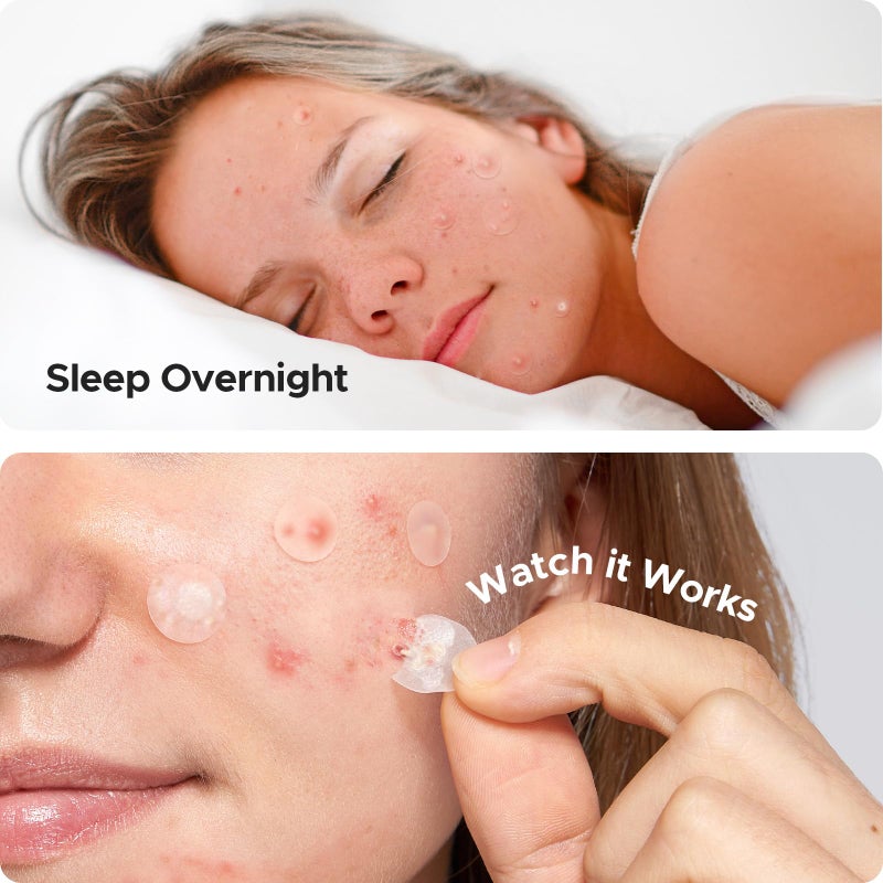 TKTK Hydrocolloid Acne Patches, Pimple Patches for Face with Tea Tree & Calendula Oil - 4 Sizes Clear Cover Stickers, Invisible for Day & Night Use (180 Count) - Image 5