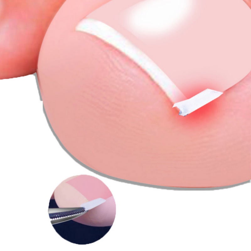 Ingrown Toenail Tools Kit Toenail Treatment Tool for Ingrown Toenail Removal Correction Toe Nail Corrector Strips Toenail Lifter Nail Clipper Foot Care - Image 2