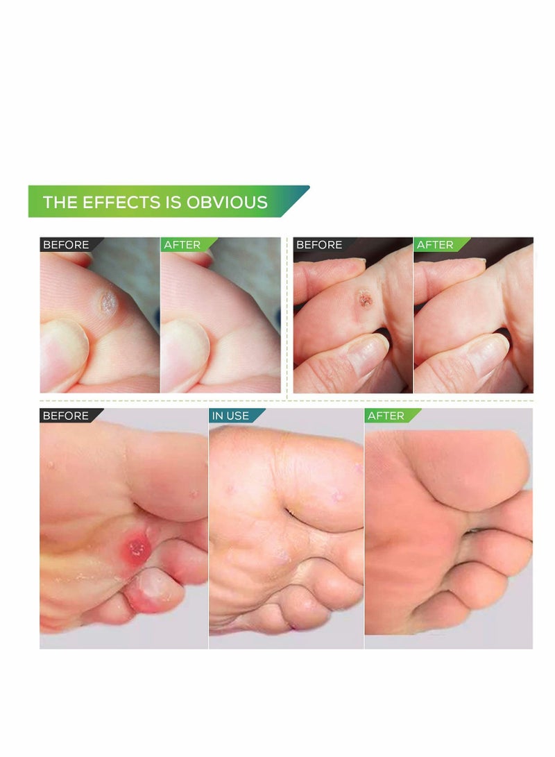 Corn Remover, 24 Corn Remover Pads, Toe Corn and Callus Removal, Corn Treatment Pads, Best Corn Remover Pads for Foot Corn Removal, 24 Pads
