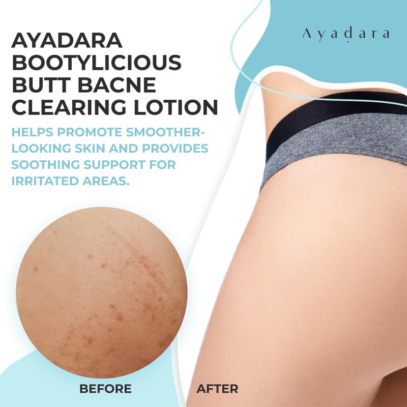 AYADARA Butt Acne Clearing Lotion and cream, 8oz with Salicylic Acid, Smoothing Butt Cream and Clearing Lotion for Women, Men, and Teens, Ideal for Chest and Back Acne, 90-Day Supply - Image 2