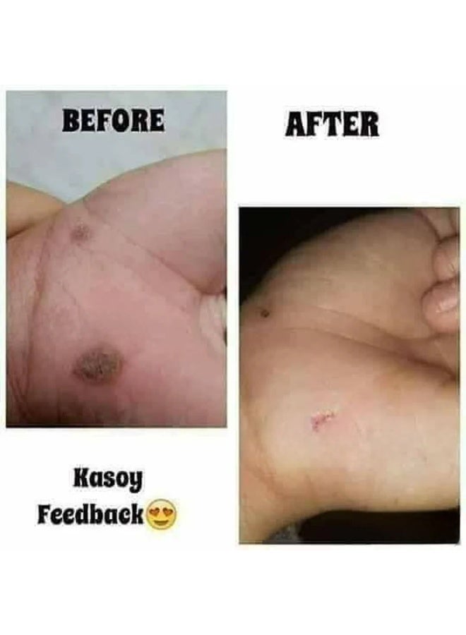ANGEL TOUCH Kasoy Cream Skin Care Solution — A Convenient Topical Cream Advertised for Supporting Care of Common Skin Concerns Such as Ringworm, Fungal Irritations, Milia, Warts, Skin Tags, Keloids, and Dermatitis with Regular Application. - Image 5