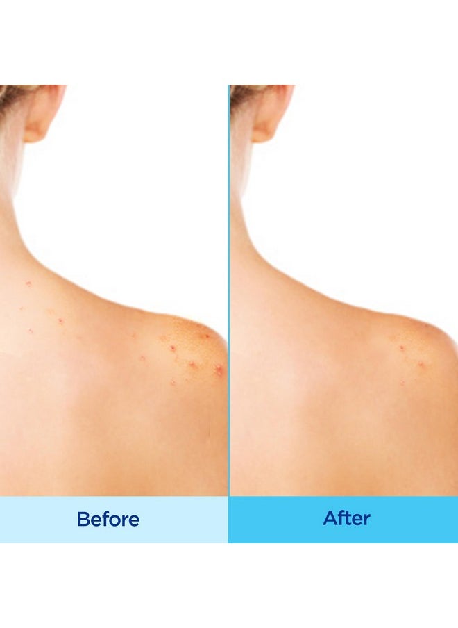 differin Differin Acne Body Spray, Acne Treatment with Salicylic Acid by the makers of Differin Gel, 360 Formula for Back Acne, Chest and Shoulders, 6 oz  - Image 3