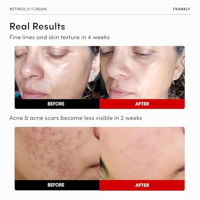 FRANKLY Retinol 0.3% Cream, 0.7 fl oz - Intensive Retinol | Night Cream | Ceramides & Natural Ginseng | Anti-aging, Wrinkles Care, Reduces Congestion and hyperpigmentation | Korean Skin Care - Image 2