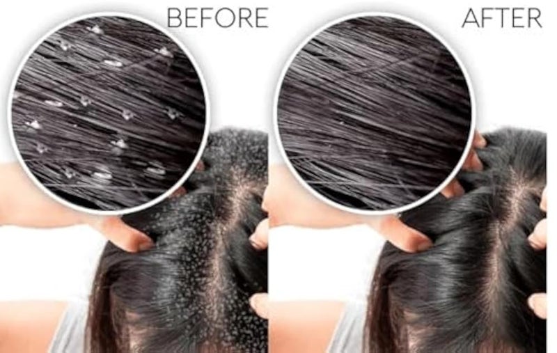 Infinity Dandel Medicated Anti-Dandruff Shampoo - Effective Dandruff & Itch Treatment with Pyrithione Zinc & Selenium + Nourishing Natural Oils - 250ml I by Al Shabrawini Pharmacy - Image 1