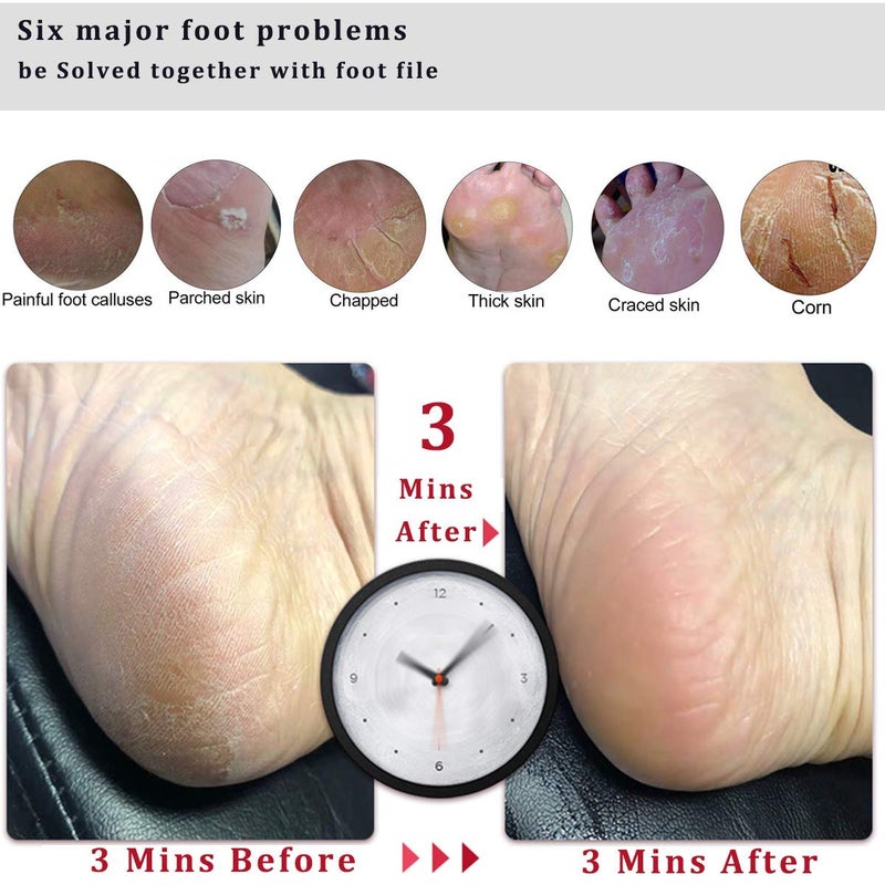 Kinepi Foot Scrubber Pedicure Foot File Pumice Stone,Professional Pedicure Supplies Callus Remove Cracked Heels,Dead Skin,Corn,Scraper File Foot Care Foot Rasp Massage Brush Tools Kit for Men/Women - Image 4