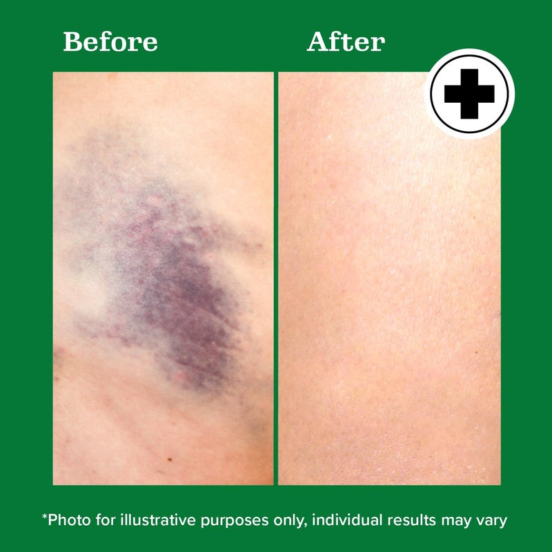 Miracle Plus Natural Arnica Bruise Body Gel | Arnica Montana Lotion For Thin Skin Bruising And Swelling After Surgery | Extra Strength Vitamin K Cream | Skin Care Arnica Ointment For Bruises, 4 Oz - Image 5