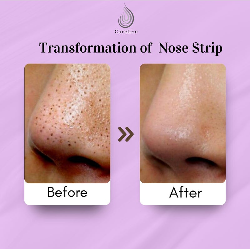 Careline Natural Deep Cleansing Nose Strips with Vitamin E & Almond Oil – 6 Strips, Blackhead Remover, Pore Purifying, - Image 5