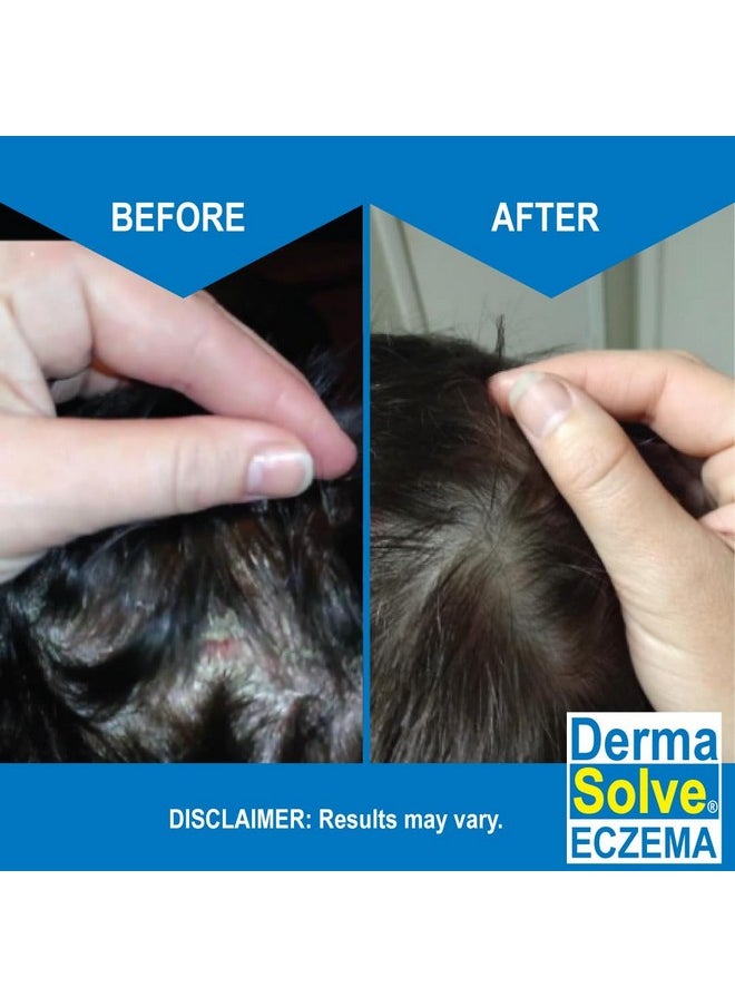 Dermasolve Dermasolve Eczema Relief Shampoo - Flare Control Scalp & Dandruff Free Therapy That Protects, Moisturizes, and Repairs Skin for Kids & Adults - Steroid Free (2-Pack)  - Image 3