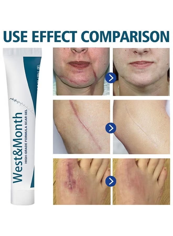 West&Month Silicone Scar Removal Gel, Hight Quality Scar Removal Gel, Acne Scar Treatment, Deep Acne Scar Removal, Burns Keloids Hypertrophic, Repair Damaged Skin, Removing Acne Marks Scar Repair Cream ﻿ - Image 2