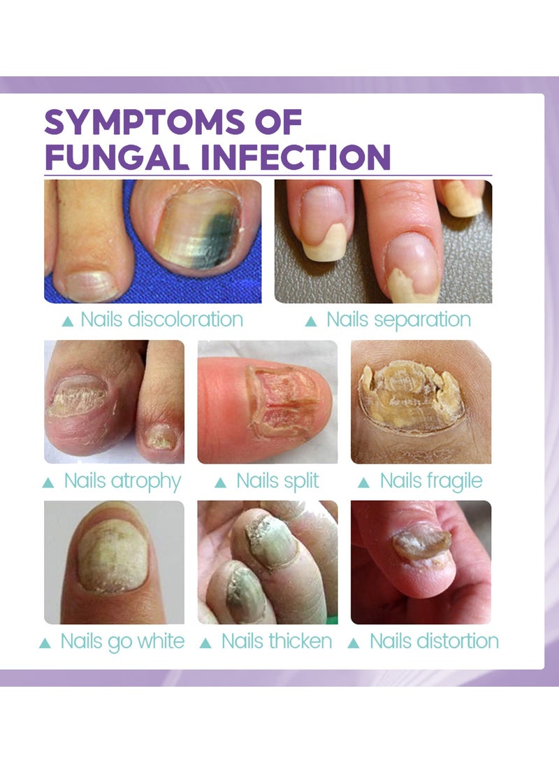 Jaysuing Nail Fungus Spray for Nail Repair Solution Onychomycosis Care - Image 2