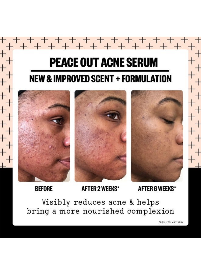 Peace Out Skincare Acne Serum. Daily Multi-Benefit Face Serum with 2% Salicylic Acid to Target Pimples, Zits, Blemishes and Breakouts, For Clearer-Looking Skin 1 fl oz - Image 3