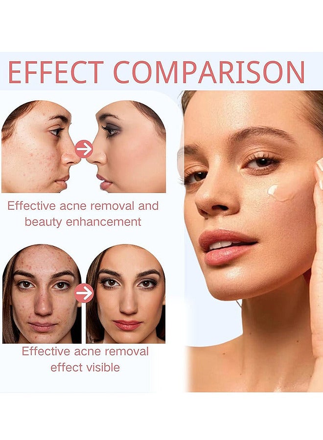 FUSHITING Azelaic Acid 15% Acne Tratment Cream, Acne Cream for Face, Spot Treatment, Anti Acne Gel For Spot Prone Skin, Rosacea Reducing Relief Pimple Breakouts Blackhead Pigmentation and Redness,Hydrate 15g - Image 5