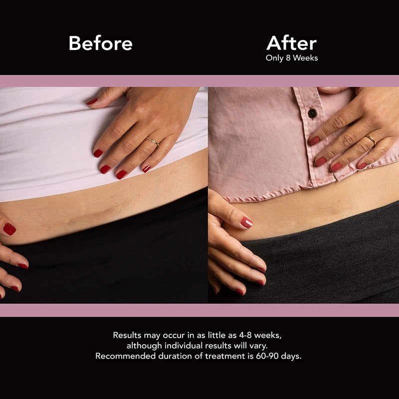 scaraway GoodSense ScarAway Advanced Skincare Silicone Scar Sheets for C-Sections, Reusable Sheets (1.5â€ x 7â€) for Hypertrophic and Keloid Scars from Injury, Burn, Surgery and more, 4 Sheets - Image 3